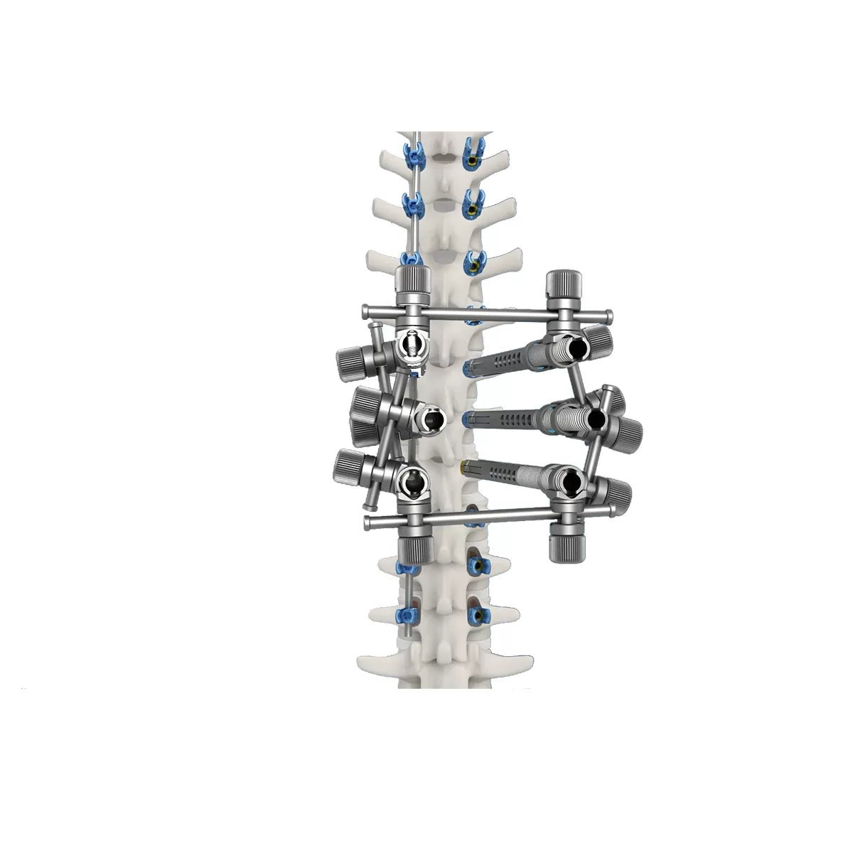 5.5 Spinal Deformity Correction Instrument Set