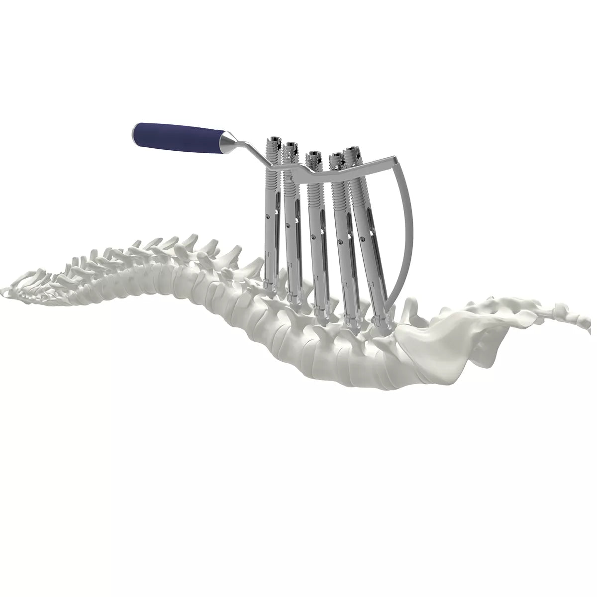6.0/6.35 mm percutaneous TL screw-rod fixation Instruments (rigid)