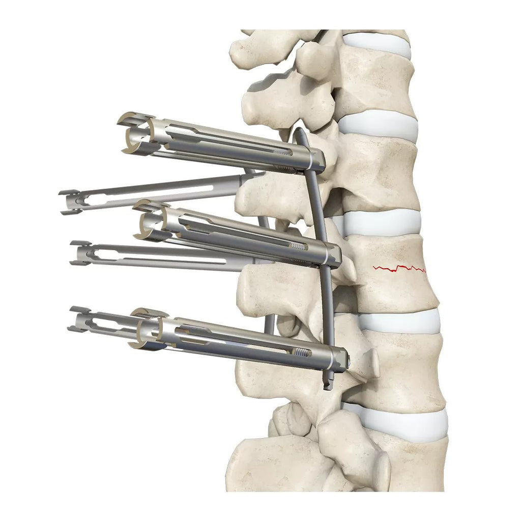 5.5mm Percutaneous MIS TL Extension Tab System