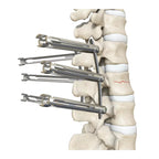 5.5mm Percutaneous MIS TL Extension Tab System