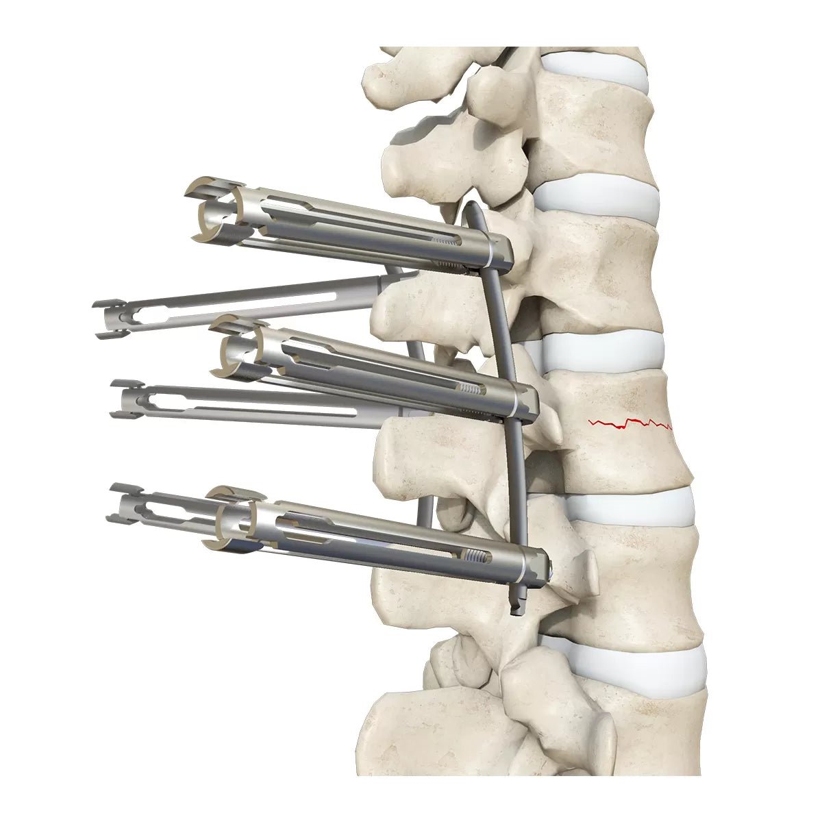 5.5mm Percutaneous MIS TL Extension Tab System