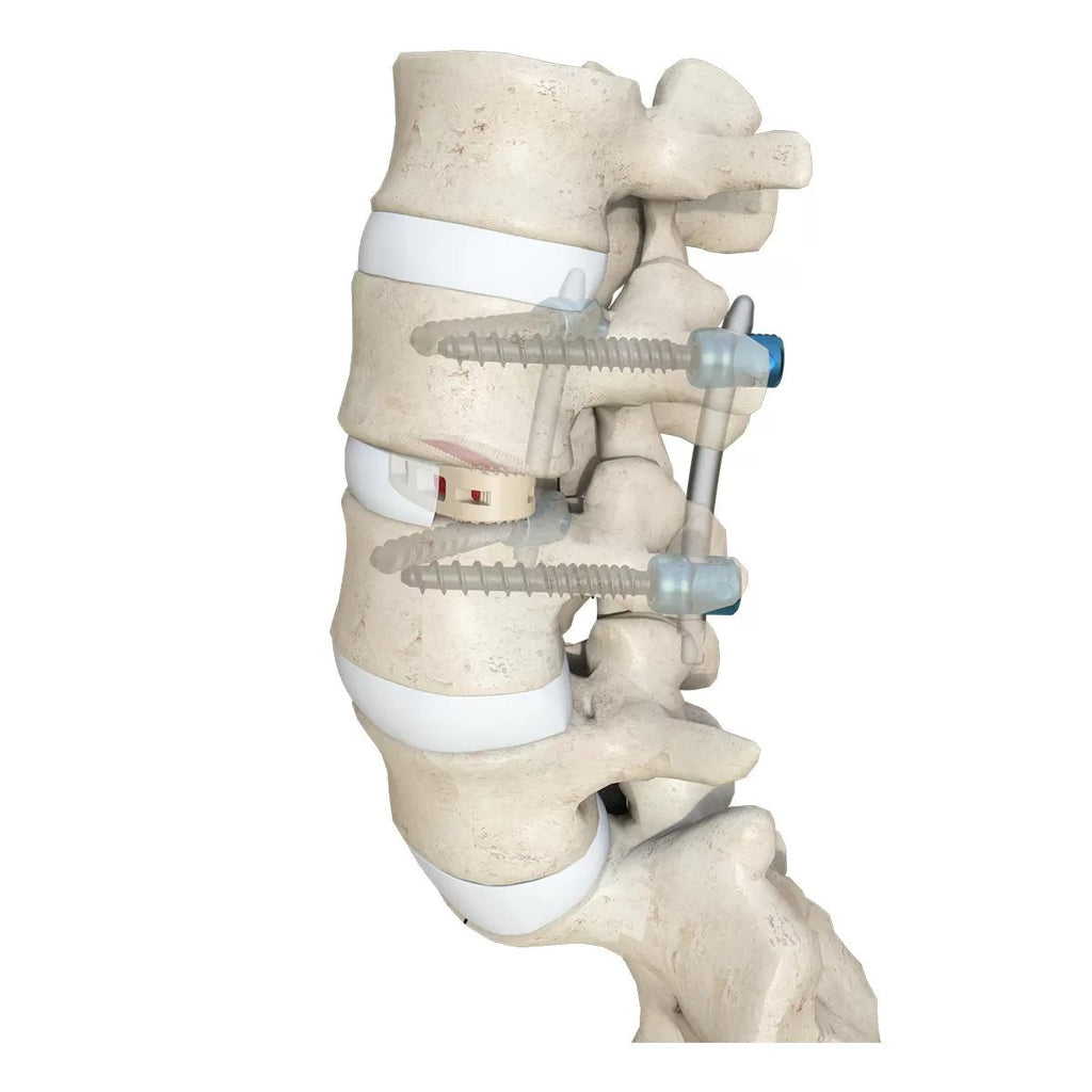 OLIF Cage Instrument Set - Insertion