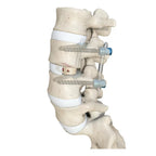 OLIF Cage Instrument Set - Insertion