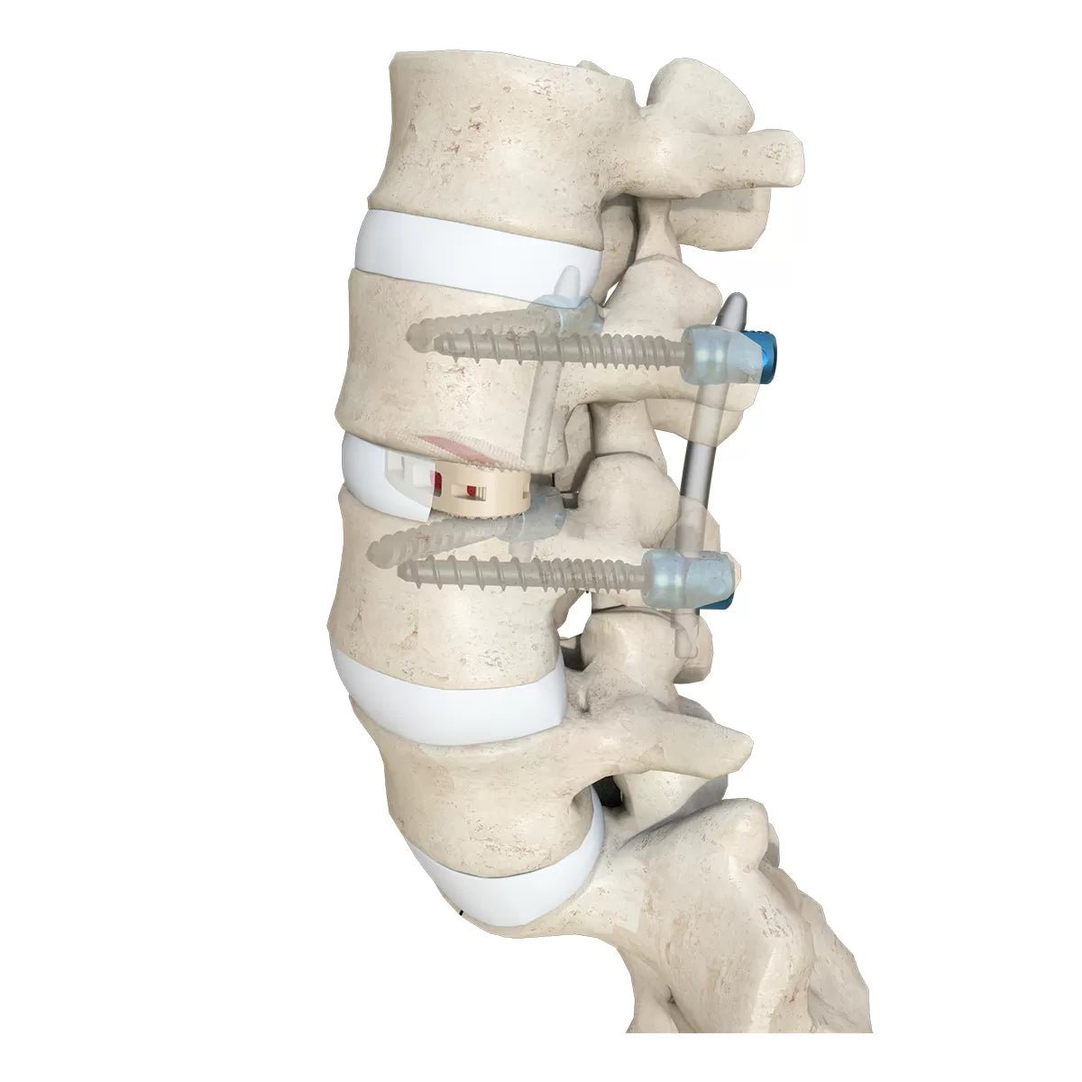 OLIF Cage Instrument Set - Insertion